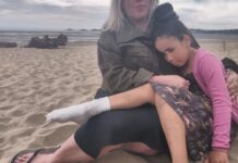 Local girl badly burned by BBQ buried on beach