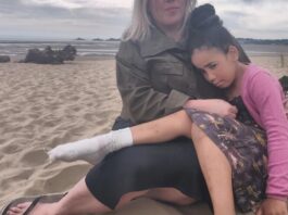 Local girl badly burned by BBQ buried on beach